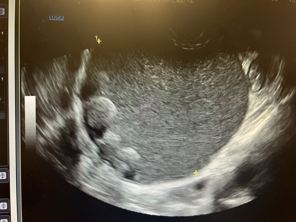 khldtaha's tweet photo. @AndyNeill @POCUS_Society @IMPOCUSFocus https://t.co/eSqdwgiRoV