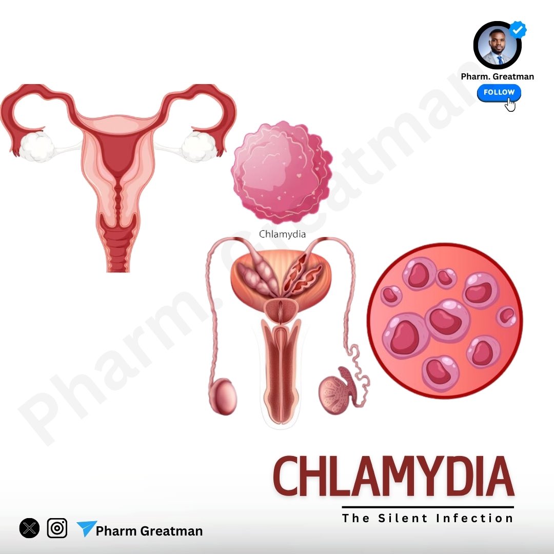 OGreat6's tweet photo. WHAT DO YOU KNOW ABOUT CHLAMYDIA?

Did you know that Chlamydia is one of the most common sexually transmitted infections, yet it is often symptom-free 😬🥶

This, earned it a nickname “the silent infection.” 😟

Learn more about chlamydia to stay safe and informed
A thread https://t.co/YHjvgl1y68