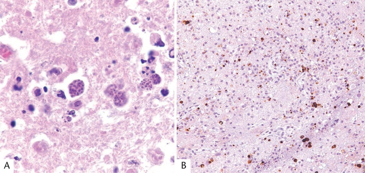 ARP_Press's tweet image. From the infectious disease fascicle (arppress.org/books/book/65):
Toxoplasmosis is caused by an obligate intracellular protozoan and is one of the most prevalent human infections worldwide (25-75%, region dependent). Many organs can be affected, including the brain.
#IDpath