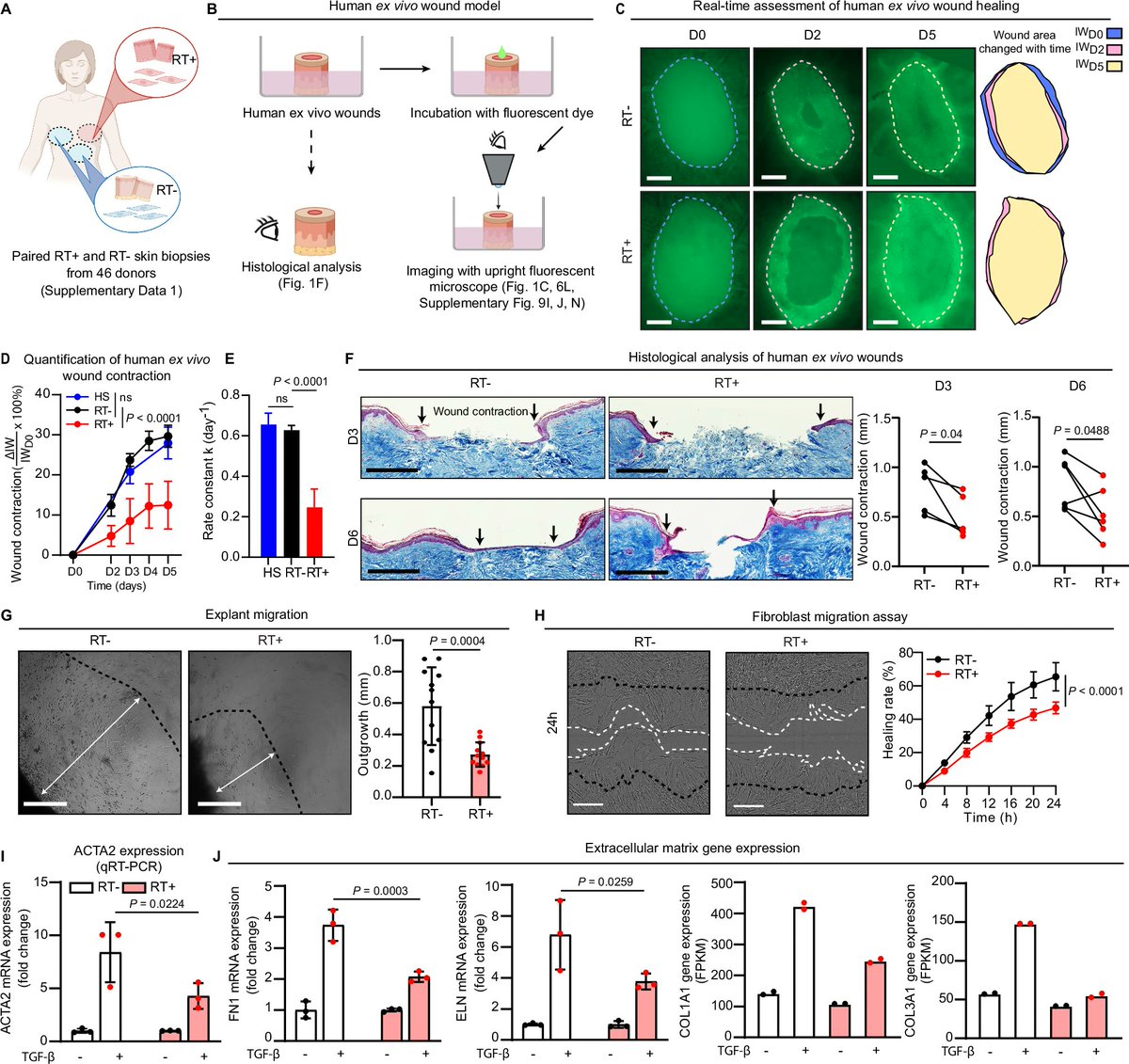 'Epigenetic memory of radiotherapy in dermal fibroblasts impairs wound repair capacity in cancer survivors'
nature.com/articles/s4146…