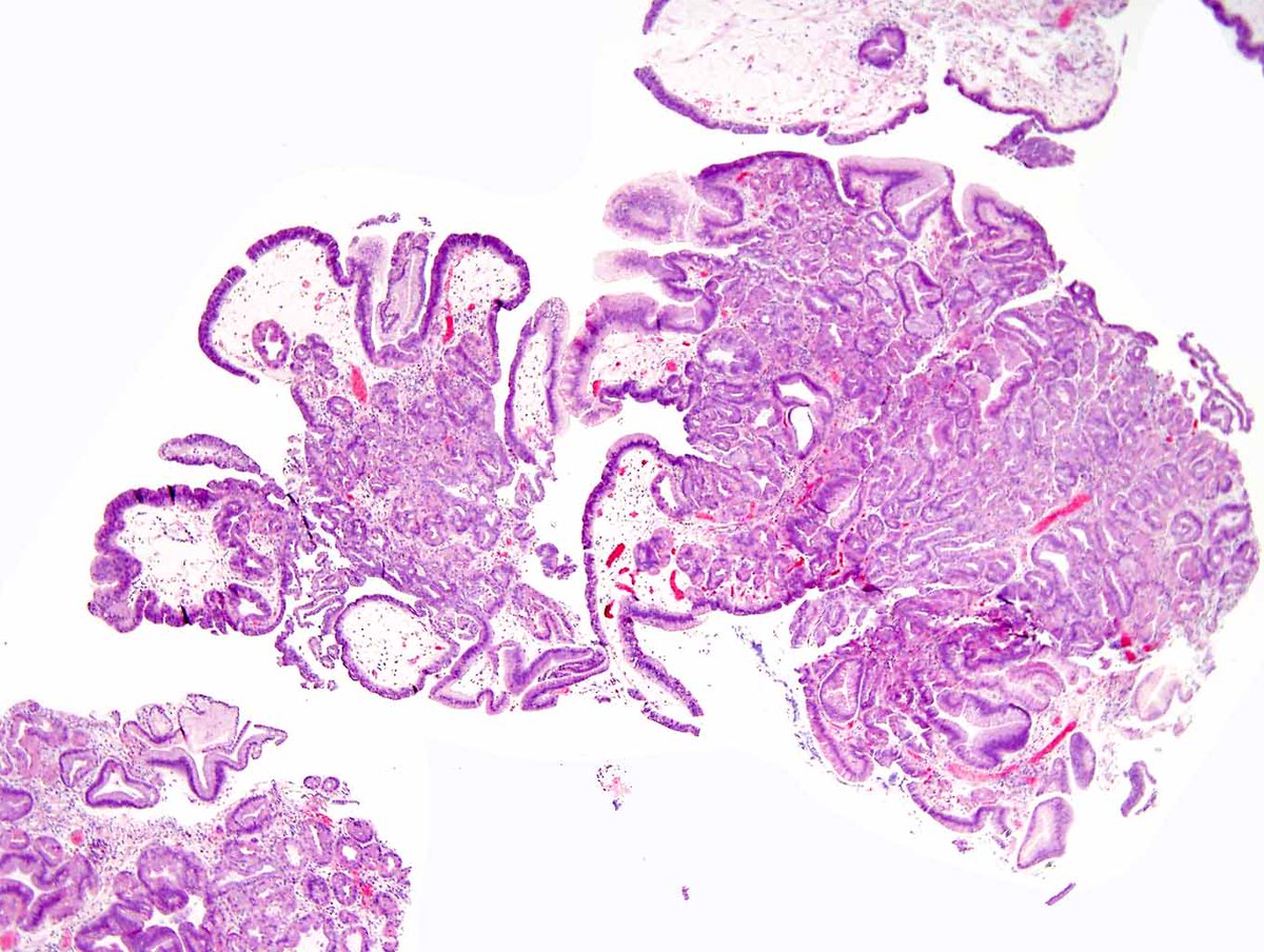 Gastric polyps with dysplasia in McCune Albright syndrome -  caused by sporadic post-zygotic mutations in  GNAS, leading to constitutional mosaicism with fibrous dysplasia of bone, precocious puberty, café au lait macules, and GI tract lesions. PMID:s 28188442;  30124968