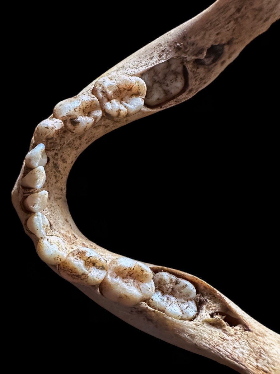 This mandible fragment presents a detailed view of a child’s dental development, with primary molars intact and no sign of eruption of the first permanent molar, commonly referred to as the “6-year molar” or simply the “6.” In dental development, the first permanent molar