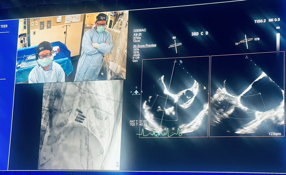 Kiran Belani, MD, FASE, FACC (@kibelani) on Twitter photo Stunning live T-TEER 3-device case by the experts <a href="/gb_mackensen/">G. Burkhard Mackensen</a> <a href="/jamiemccabeMD/">Jamie McCabe</a> <a href="/CJChungMD/">Christine Chung</a> <a href="/RichardSheuMD/">Richard Sheu</a> at <a href="/UWMedHeart/">UWashington Heart Institute</a> … and at lightning speed! Stunning live T-TEER 3-device case by the experts <a href="/gb_mackensen/">G. Burkhard Mackensen</a> <a href="/jamiemccabeMD/">Jamie McCabe</a> <a href="/CJChungMD/">Christine Chung</a> <a href="/RichardSheuMD/">Richard Sheu</a> at <a href="/UWMedHeart/">UWashington Heart Institute</a> … and at lightning speed!