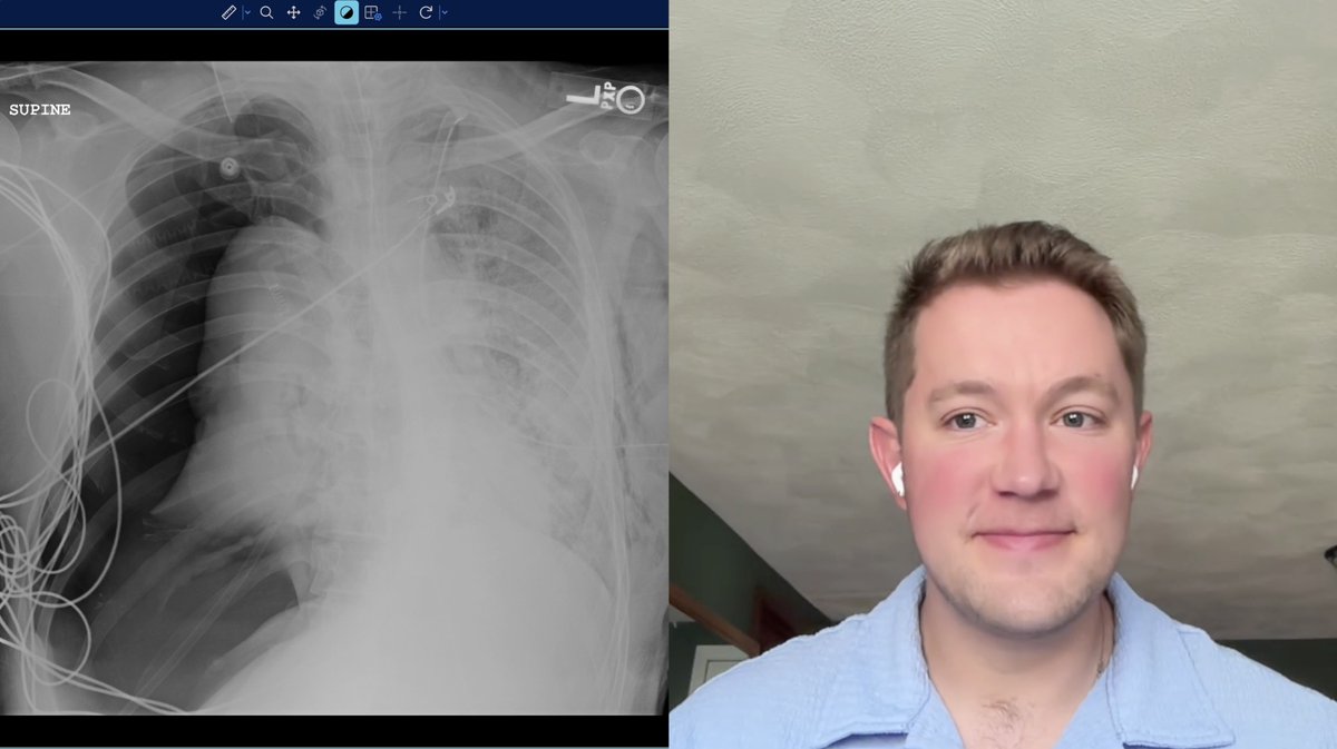 theradclerk's tweet photo. Our latest demo is up! Watch @theradclerk student Matt Swanson take apart this chest radiograph on his Chest Radiography rotation.

https://t.co/1YWJftp9f4

#MedEd #radiology https://t.co/RgtcsC4R1W