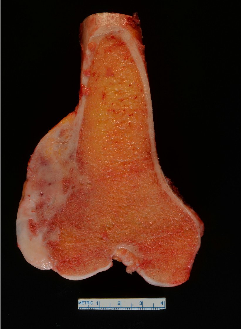 Nooshin_Dashti's tweet photo. Young pt. Classic location: surface, post femur (knee). MDM2 amp would be helpful. https://t.co/2iTyGLDaCI