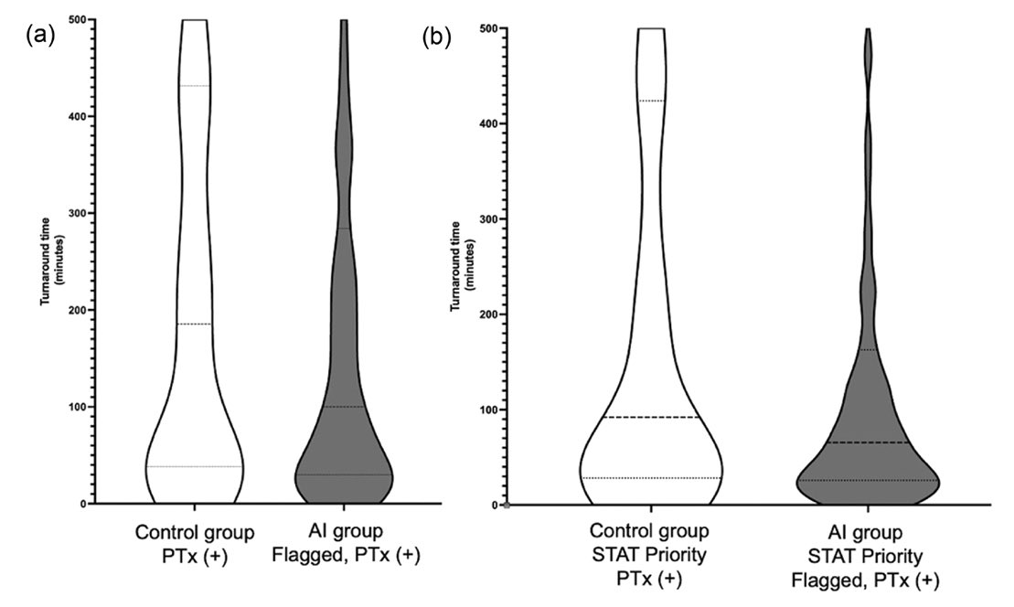 Amit Gupta (@amitgupta_83) on Twitter photo Thrilled to share our latest study showing the real-world impact of an FDA-cleared AI tool for pneumothorax detection.
A step forward in faster diagnoses and better care!
sciencedirect.com/science/articlā¦
<a href="/UHRadiology/">UH Radiology Cleveland</a> <a href="/UHhospitals/">University Hospitals</a>
#AcademicRadiology Thrilled to share our latest study showing the real-world impact of an FDA-cleared AI tool for pneumothorax detection.
A step forward in faster diagnoses and better care!
sciencedirect.com/science/articlā¦
<a href="/UHRadiology/">UH Radiology Cleveland</a> <a href="/UHhospitals/">University Hospitals</a>
#AcademicRadiology