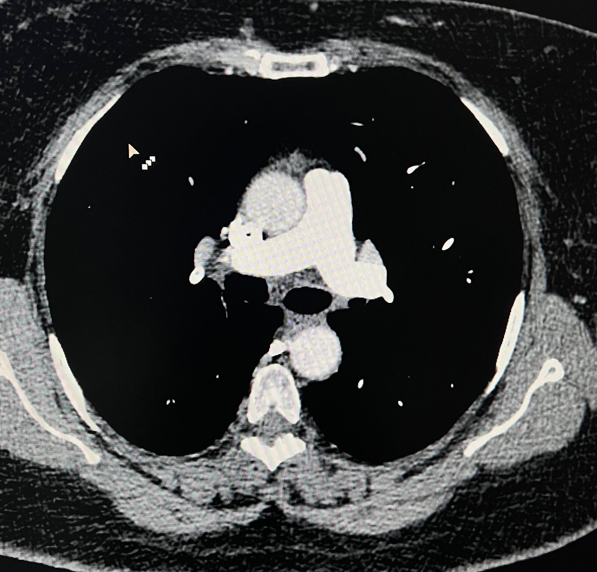 abdullah7517's tweet photo. #الاشعة #radiology
PE Angio https://t.co/KQw3ckR1JW