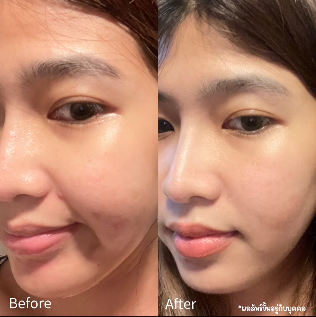 ffai_prc's tweet image. เริ่ดมากกับการเปลี่ยนโฟมล้างหน้าในรอบปี ใช้มา 7วันแล้ว บอกเลย NIVEA Derma Acne Care ผลลัพธ์เกินคาดมาก ผิวใสขึ้น รอยสิวจากลง ปิดสวิตซ์วงจรสิวให้ผิวมูฟออนจริง แถมหลังล้างหน้าผิวไม่แห้ง ล็อคความชุ่มชื้นสุดๆๆ สุดท้ายๆๆๆ ผิวแพ้ง่ายใช้ได้ด้วย อ่อนโยนกับผิวสุดๆๆ #Letsmoveon