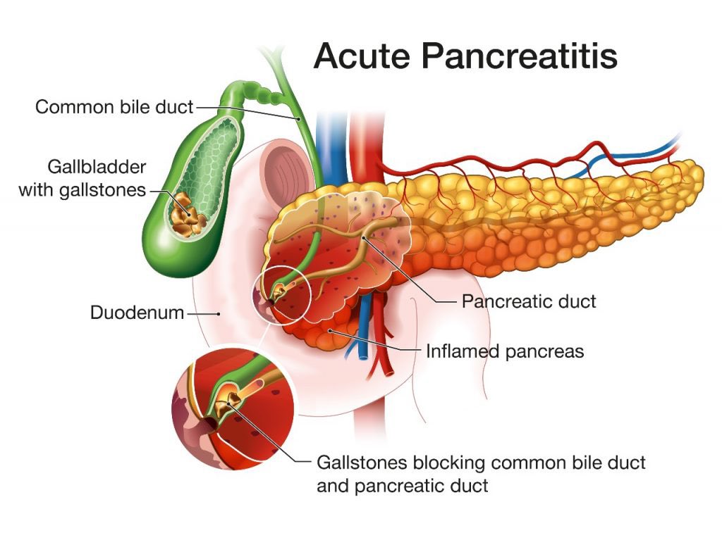 world_of_med1's tweet photo. ايش أفضل محلول نستخدمه في 
acute pancreatitis  
و كم الrate 
و هل نفضل نستخدم aggressive or moderate resuscitation  ؟ https://t.co/sfuL7s4F2I
