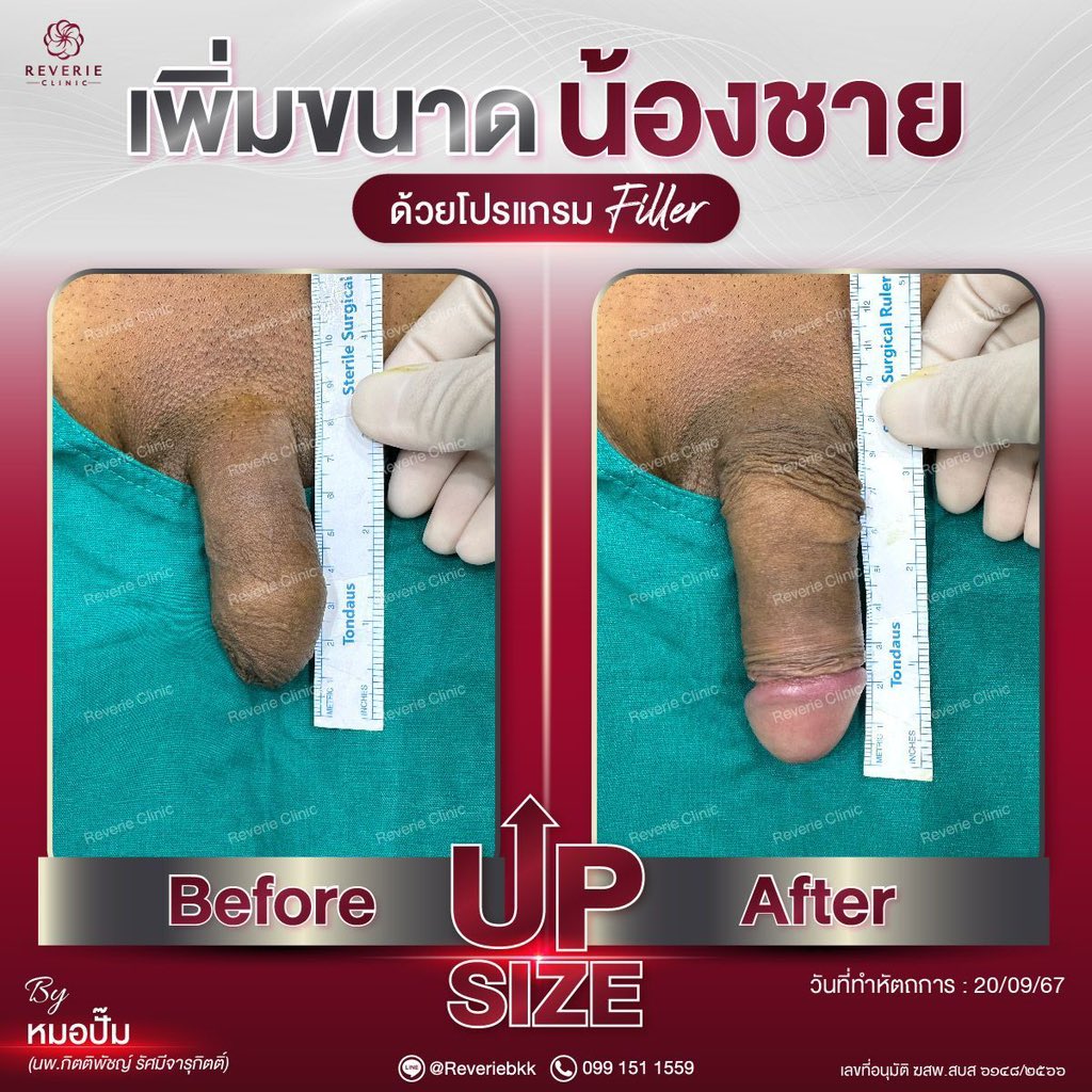 <a href="/drpump_upsize/">หมอปั๊ม เพิ่มขนาด</a> น้องชายเล็กไม่ใช่ปัญหา ฟิลเลอร์จัดให้ใหญ่ มั่นใจได้เต็มที่! #เพิ่มขนาด  #เพิ่มขนาดน้องชาย #อัพไซต์ #upsize #หมอปั๊ม #เคใหญ่ #นัดเย็ด #fwb #เย็ดหมู่ #อยากโดนดูดควย #ควยใหญ่ #อยากควยใหญ่