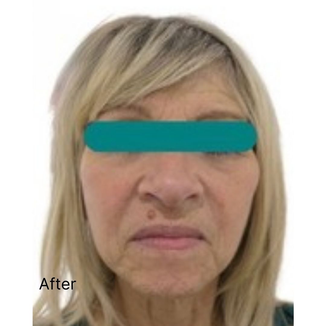 ✨ Look younger instantly with our Non-Surgical Face Lift! ✨ Achieve a refreshed, youthful glow—no surgery or downtime needed. Book now to experience the results yourself!

📧 info@hedoxclinic.co.uk
📞 02081857273

#DrHumble #NonSurgical #AntiAging #YouthfulSkin #HedoxClinic