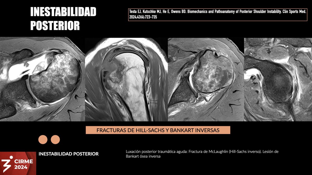 DmcRadiologia's tweet photo. Luxación traumática aguda reducida en un jugador de rugby. Defecto óseo bipolar con lesión de Hill-Sachs inversa (fractura de McLaughlin) y lesión de Bankart ósea inversa menor.
Un día para inicio de CIRME 2024 en BsAs. Abierta modalidad online.
https://t.co/osGcbwQc1a https://t.co/fn0Fl8eSo9