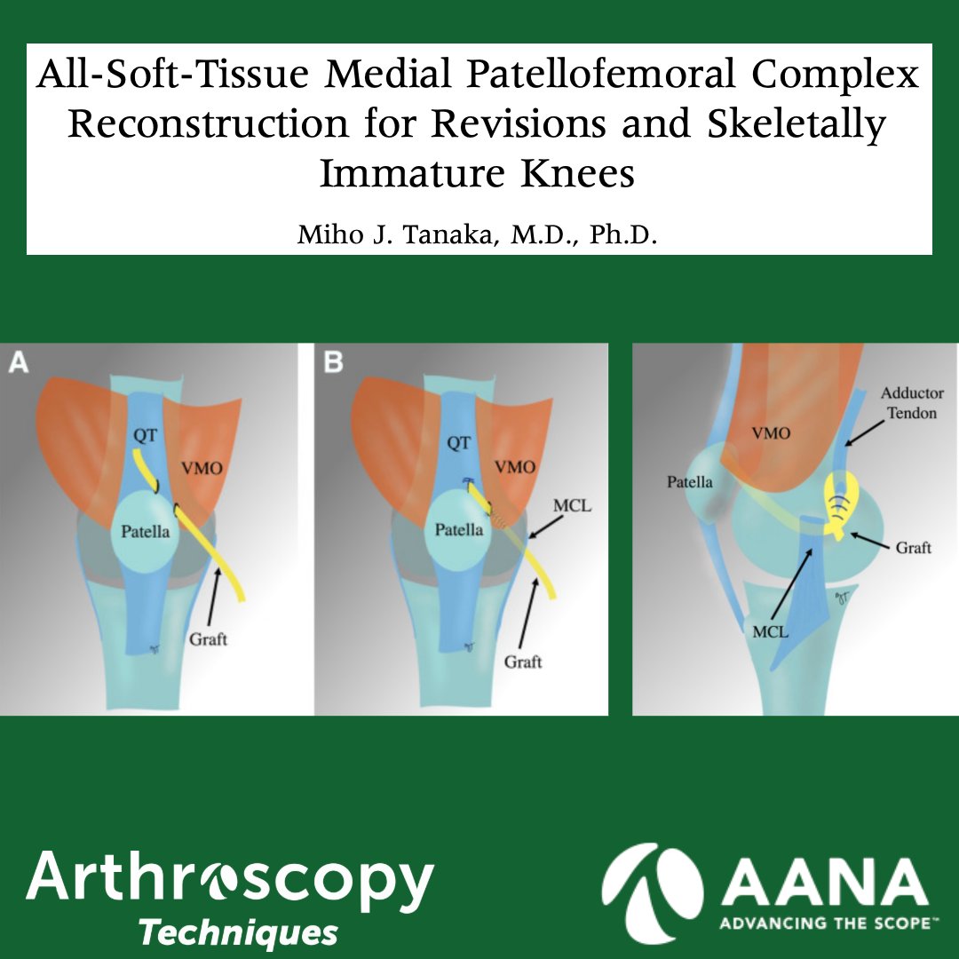 ArthroscopyJ's tweet photo. All-Soft-Tissue Medial Patellofemoral Complex Reconstruction for Revisions and Skeletally Immature Knees
#KneeSurgery #Patellofemoral #SoftTissueReconstruction @DrMihoTanaka
https://t.co/kFq8eoEHQS https://t.co/jMlMTHwGOc