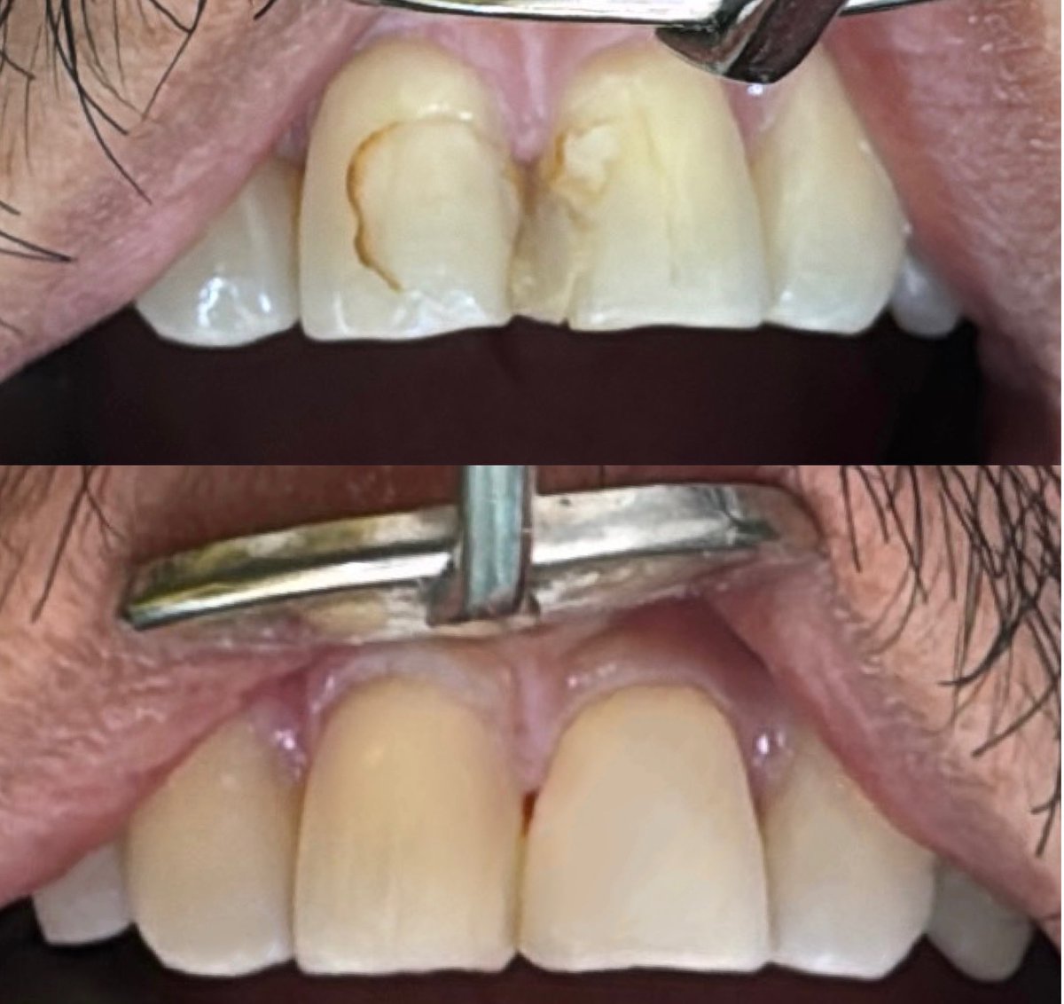 Dr_TASM's tweet photo. #11 - #21 
Change composite restoration https://t.co/lKFzQpMlAC