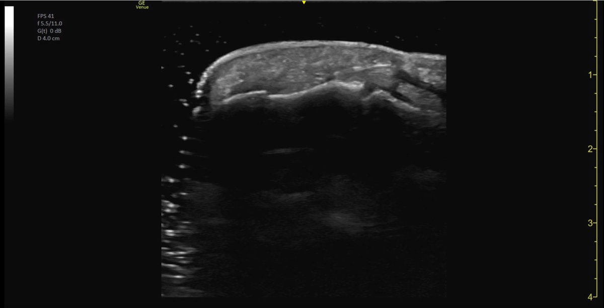 EUSmkh's tweet image. Students: What tissue structures do you see in this image?
Residents: What is causing this person’s pain?
#raysofgray #POCUS #ultrasound #FOAMed #MedEd #emergencymedicine #medicalstudent #resident