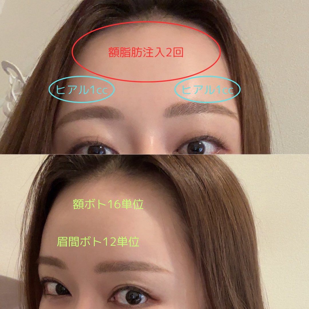 seikeibakari's tweet photo. 眉上の凹みを治す方法は至って簡単で、

①額・眉間ボトで筋肉の動きを抑える
②骨格の凹みを埋める(範囲広いなら脂肪、狭いならヒアル)

の順番が良い
剃った眉毛の青みが気になる人はジェントルで医療脱毛 https://t.co/lRGWzXBBuH
