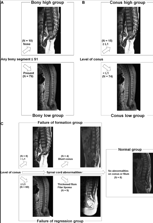 Neurosurgery Publications (@neurosurgerycns) on Twitter photo #NEUNew Caudal Agenesis: Classification Based on the Pathoembryogenesis of the Spinal Cord bit.ly/3YK3ICk by Shim et al <a href="/snuh_official/">Seoul National University Hospital</a> <a href="/SmrutiPatelMD/">Smruti Patel, MD</a> <a href="/CNS_Update/">CNS</a> <a href="/DKondziolkaCNS/">Douglas Kondziolka</a> <a href="/george_maragkos/">George Maragkos, MD</a> <a href="/Zaazoue/">Mohamed Zaazoue</a> <a href="/urquiagajf_MD/">Jorge F. Urquiaga</a> <a href="/e_celano/">Emma Celano</a> <a href="/LKReedMD/">Laura K. Reed, MD</a> <a href="/jh_kanterMD/">John Kanter</a> #NEUNew Caudal Agenesis: Classification Based on the Pathoembryogenesis of the Spinal Cord bit.ly/3YK3ICk by Shim et al <a href="/snuh_official/">Seoul National University Hospital</a> <a href="/SmrutiPatelMD/">Smruti Patel, MD</a> <a href="/CNS_Update/">CNS</a> <a href="/DKondziolkaCNS/">Douglas Kondziolka</a> <a href="/george_maragkos/">George Maragkos, MD</a> <a href="/Zaazoue/">Mohamed Zaazoue</a> <a href="/urquiagajf_MD/">Jorge F. Urquiaga</a> <a href="/e_celano/">Emma Celano</a> <a href="/LKReedMD/">Laura K. Reed, MD</a> <a href="/jh_kanterMD/">John Kanter</a>