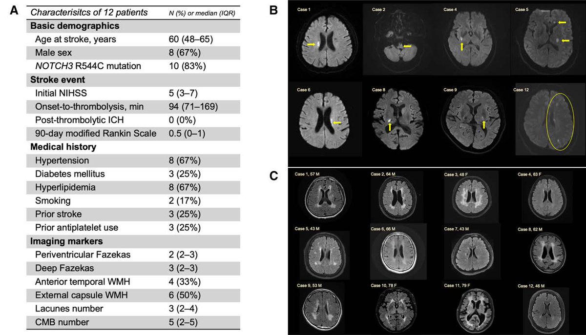 🧵The efficacy and risk profile of intravenous thrombolysis in people with CADASIL are poorly understood. In this retrospective observational cohort study, the authors describe the real-world outcomes of patients with CADASIL exposed to IV thrombolysis in a multicenter setting.