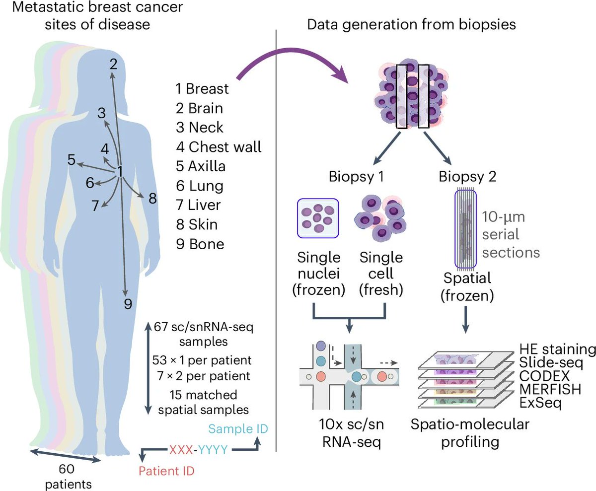 Daniel Abravanel, MD/PhD (@drdabravanel) on Twitter photo Excited to share our latest work in <a href="/NatureMedicine/">Nature Medicine</a> as part of #HTAN to generate a spatial and cellular map of metastatic breast cancer with important technical, translational, and biological implications and multidisciplinary utility as a resource: rdcu.be/dYAVP Excited to share our latest work in <a href="/NatureMedicine/">Nature Medicine</a> as part of #HTAN to generate a spatial and cellular map of metastatic breast cancer with important technical, translational, and biological implications and multidisciplinary utility as a resource: rdcu.be/dYAVP