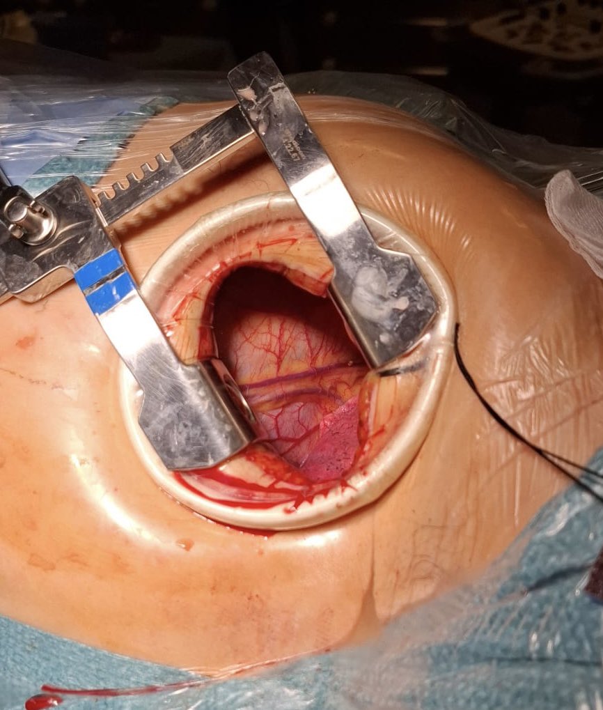 ⚠️when mapping blind the epicardial surface of the left ventricle never forget this important structure to be marked in between of the two veins.🏴‍☠️