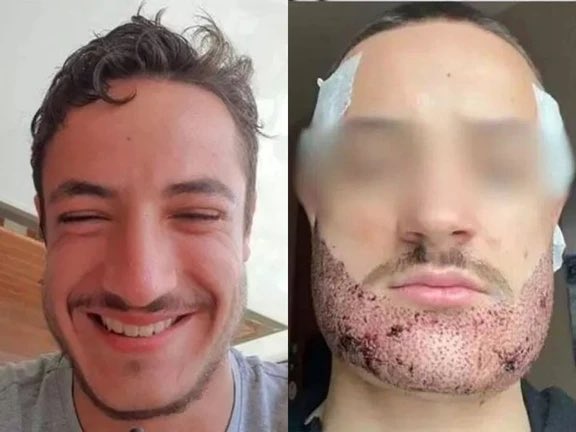 MorbidKnowledge's tweet image. Mathieu Vigier Latour, a 24-year-old student from France, tragically ended his life after an unsuccessful beard transplant. 

He had undergone the procedure in Turkey, drawn by the lower cost compared to similar options in France, only to discover afterward that the person…