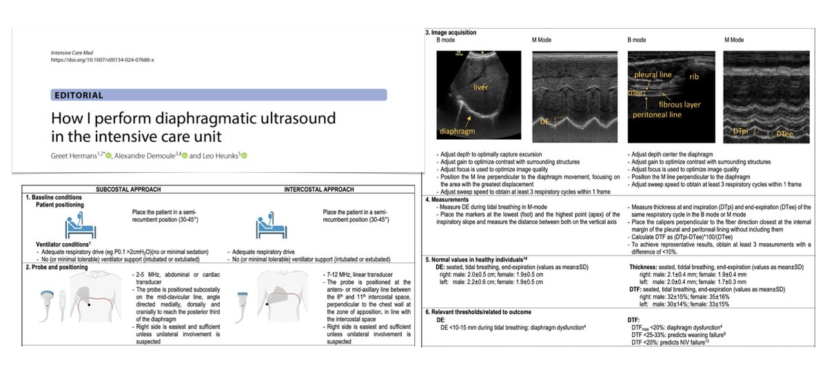 How I perform diaphragmatic #ultrasound in #ICU 
🖥️ practical aspects: subcostal approach, intercostal approach
🖥️ areas of application in daily care
🖥️ future prospects
Free to read #FOAMcc #FOAMus #echofirst 
🔓 rdcu.be/dYy6l