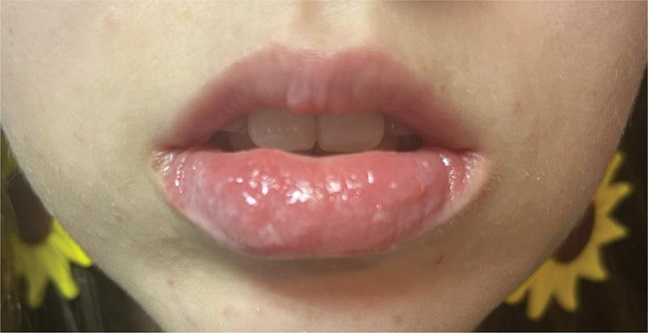 AJDP_Journal's tweet photo. #ClinicalPathologicChallenge
20F presented with a 2-year h/o pruritic erosive lesions on her lower lip that occur in spring and early summer. On physical examination - enlarged erythematous lower lip with tiny erythematous papules and crusts.
What's your Dx?
Any IHC? https://t.co/8KsGAPJE8E