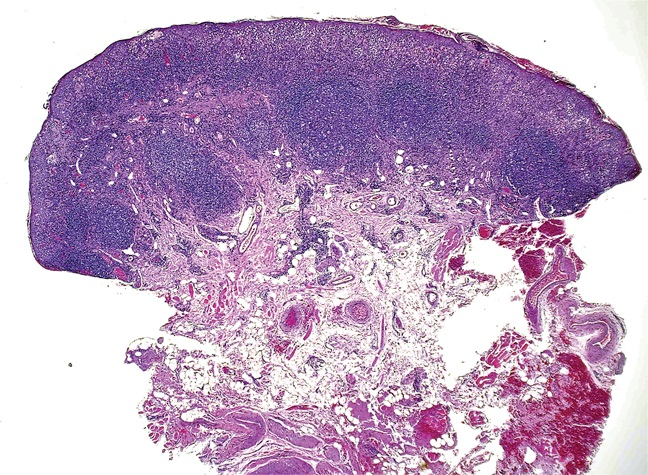 AJDP_Journal's tweet photo. #ClinicalPathologicChallenge
20F presented with a 2-year h/o pruritic erosive lesions on her lower lip that occur in spring and early summer. On physical examination - enlarged erythematous lower lip with tiny erythematous papules and crusts.
What's your Dx?
Any IHC? https://t.co/8KsGAPJE8E