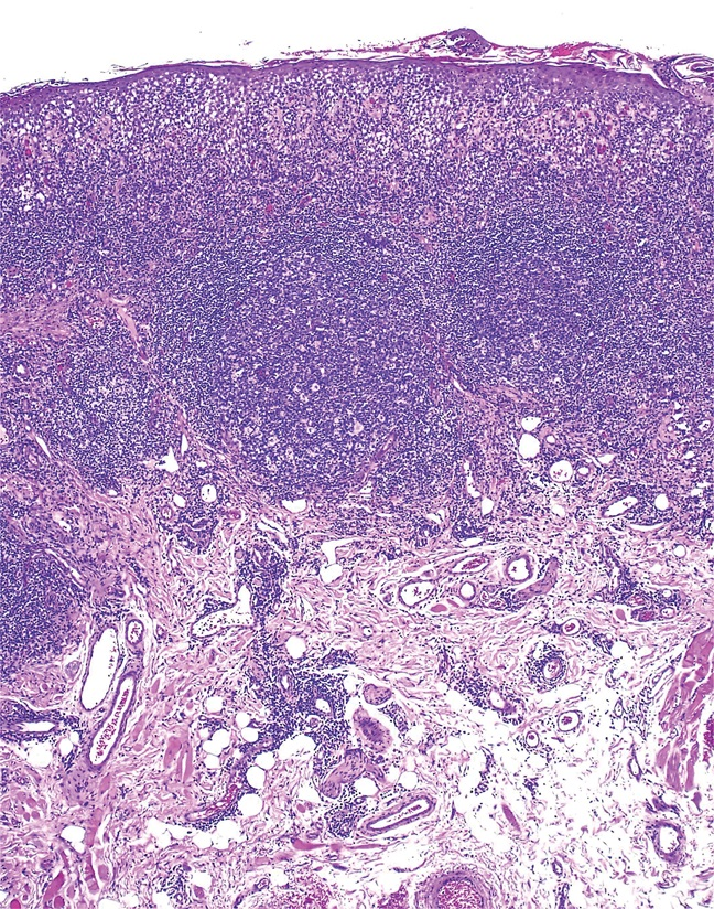 AJDP_Journal's tweet photo. #ClinicalPathologicChallenge
20F presented with a 2-year h/o pruritic erosive lesions on her lower lip that occur in spring and early summer. On physical examination - enlarged erythematous lower lip with tiny erythematous papules and crusts.
What's your Dx?
Any IHC? https://t.co/8KsGAPJE8E