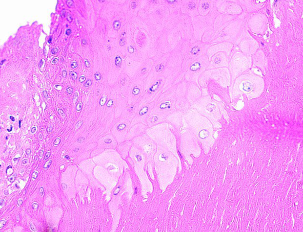 Pathology_mcqs's tweet photo. Ghost cells! 👻
🔬In a trichilemmal cyst, along with all calcifications and cholesterol clefts!
Happy Halloween, patho-fam! #GhostCells #SpookyPathology #TrichilemmalCyst” #Pathtwitter https://t.co/FFyUif34n4