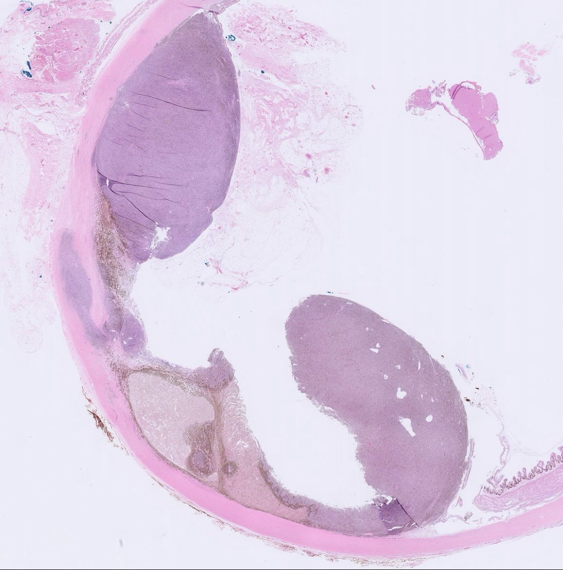 PeterKobalka's tweet image. Large choroidal melanoma with perineural invasion and &amp;gt;5mm extraocular extension. This alone gets it to pT4e.  Unsurprisingly, a liver mass soon developed #pathx #pathtwitter #cnspath #neuropath #neuropathology