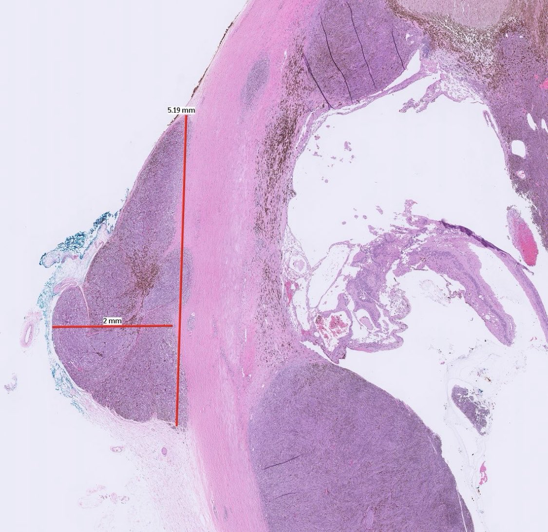 PeterKobalka's tweet image. Large choroidal melanoma with perineural invasion and &amp;gt;5mm extraocular extension. This alone gets it to pT4e.  Unsurprisingly, a liver mass soon developed #pathx #pathtwitter #cnspath #neuropath #neuropathology