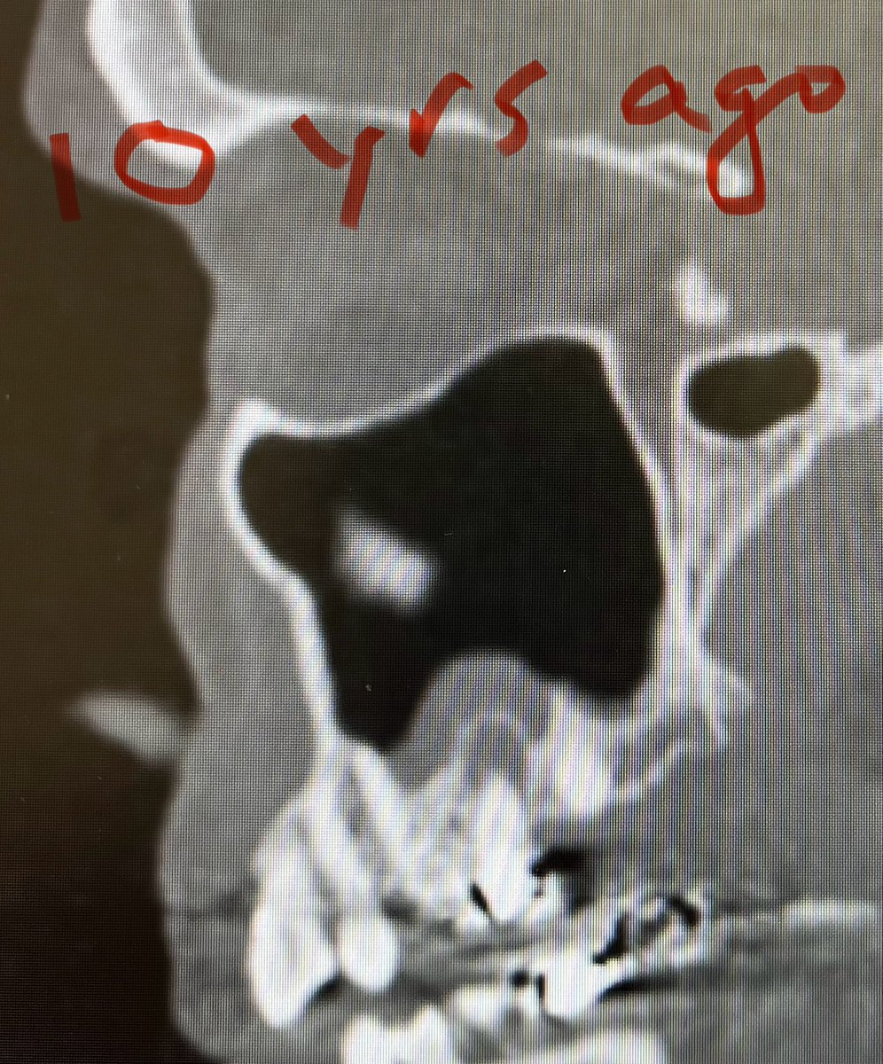 JohnCraigNose's tweet photo. Big things can start small…maybe we ENTs should look for dental pathology on all sinus CT scans, and refer pts to proper dental specialists! 😎 @ent_ams @MartaKwiat_ska @henryfordent @N_ChapurinMD @MakaryENT @jakeeide1 https://t.co/9SYJaBI6qn