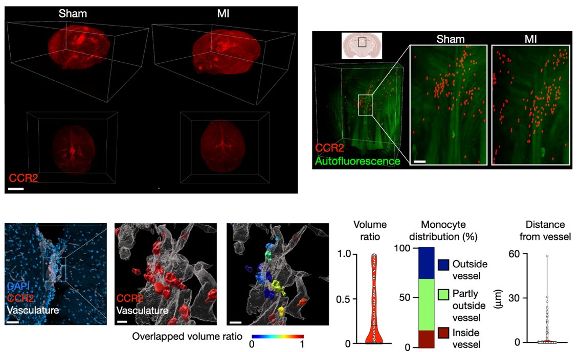 After MI, microglia recruit monocytes to the brain’s thalamus via the choroid plexus and 3ed ventricle. Once in the lateral posterior nucleus of the thalamus, monocytes gain the capacity to produce TNF which engages a subset of glutamatergic neurons to instigate a sleep circuit.