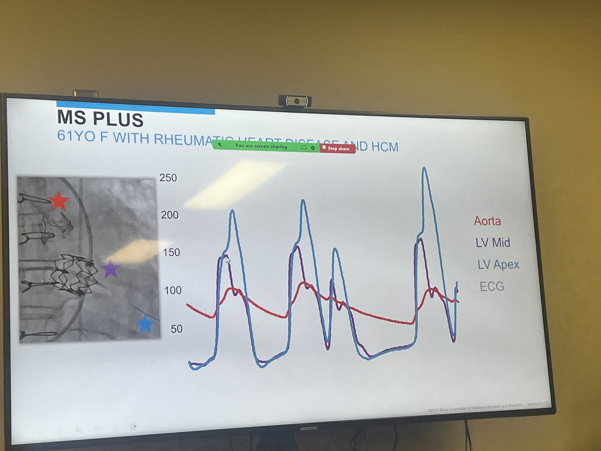 Dr. Purvi Parwani (@purviparwani) on Twitter photo Great morning welcoming <a href="/JaeKOh2/">Jae K. Oh</a> to <a href="/LLUHPhysicians/">LLUHphysicians</a> <a href="/LLUHealth/">Loma Linda U. Health</a> for two days as the visiting Professor.
Loved fantastic cases at the morning conference with hemodynamic correlation.
Super Packed two days planned.
Stay tuned for more slides.
<a href="/DennisGrewal/">Dennis G</a> <a href="/AAHilliardMD/">Anthony Hilliard</a> Great morning welcoming <a href="/JaeKOh2/">Jae K. Oh</a> to <a href="/LLUHPhysicians/">LLUHphysicians</a> <a href="/LLUHealth/">Loma Linda U. Health</a> for two days as the visiting Professor.
Loved fantastic cases at the morning conference with hemodynamic correlation.
Super Packed two days planned.
Stay tuned for more slides.
<a href="/DennisGrewal/">Dennis G</a> <a href="/AAHilliardMD/">Anthony Hilliard</a>