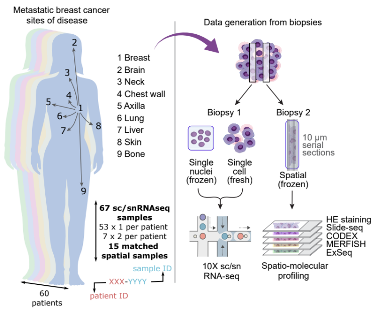 📢 Out in Nat Med: Single-cell, nucleus &amp; 4 types of spatial expression data across the clinicopathological diversity of metastatic breast cancer!
We find surprising within-patient stability, spatial EMT phenotypes, local immune exclusion, and more + comparison across methods🔗➡️