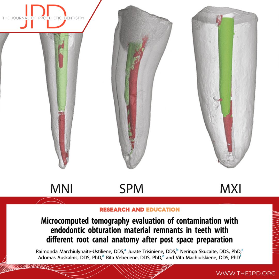 JPDentistry's tweet image. Glass fiber posts can commonly fail when adhesion between the cement and #dentin within the prepared canal space is lost due to factors like debris hindrance. This study investigates the amount of contamination that occurs after post-space preparation: thejpd.org/article/S0022-…