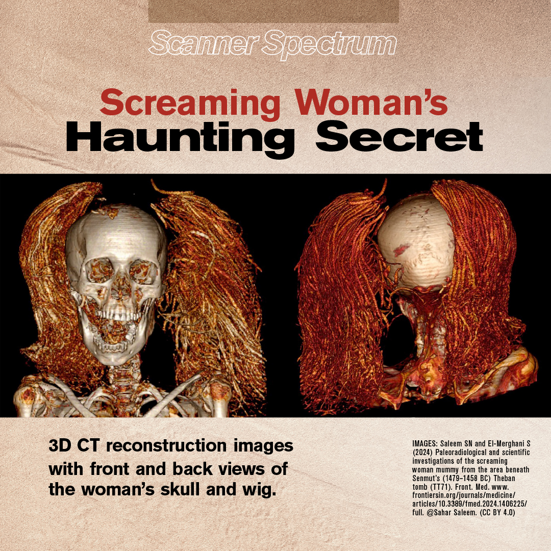 Cairo University professor Sahar Saleem uncovered disturbing details about the so-called Screaming Woman, a 3,500-year-old Egyptian mummy. Discover the secret in the current issue of Scanner. bit.ly/2Wnjhgn