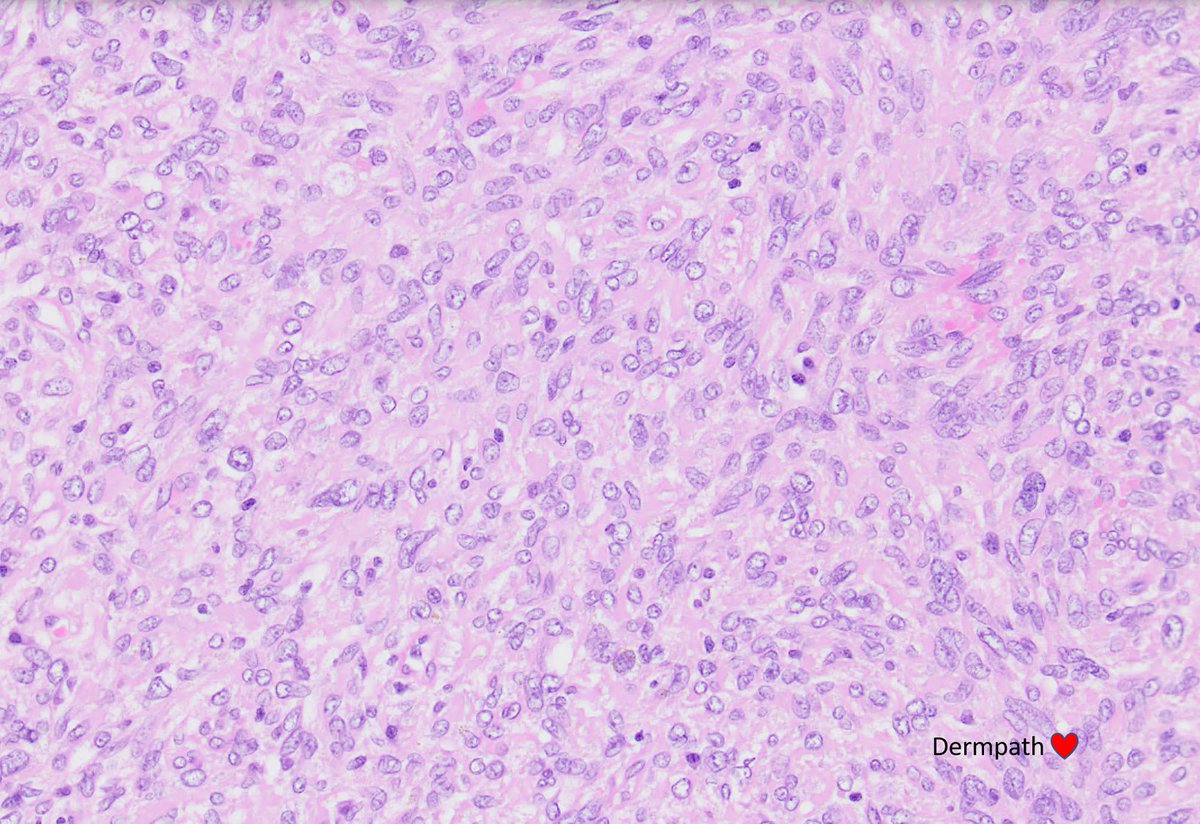 Took me a while to 'get' this case. Radiology = haematoma. dx? diffs? #dermpath