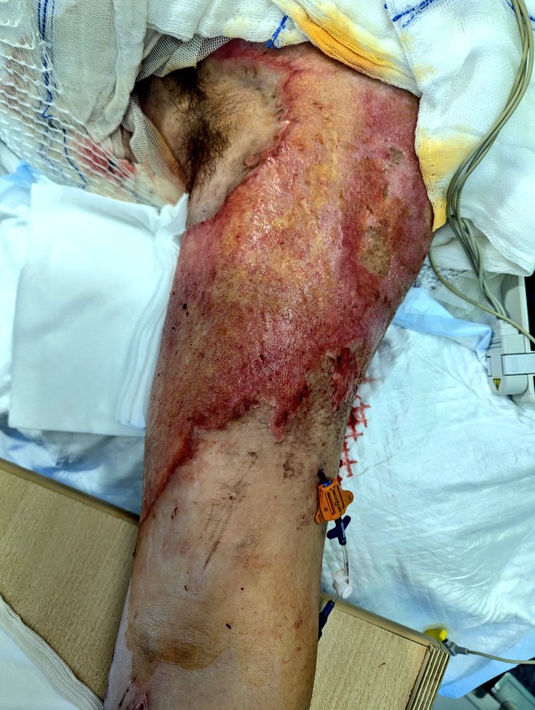 SantiVecinoV's tweet photo. La tunelizacion es una herramienta imprescindible en el gran quemado, especialmente con tunelizador romo, ya que permite túneles más largos. En este caso  18 cm de túnel sc para salvar la zona quemada , insertion site en v. Axilar y éxito site en tercio distal de brazo. https://t.co/c3eIZ43JoS