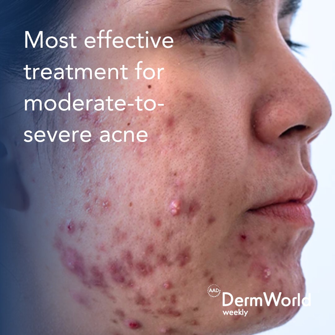 Researchers conducted a systematic review and network meta-analysis in <a href="/JDDOnline/">Journal of Drugs in Dermatology (JDD)</a> comparing the effectiveness of moderate-to-severe #acnetreatments. Researchers included 85 studies in their investigation and found that topical triple-agent fixed-dose...aad.org/dw/weekly/sept…