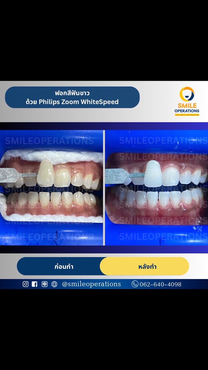 SmileOperations's tweet photo. ✨ฟอกฟันขาวด้วยระบบ Zoom!✨ เทคโนโลยีเร่งแสง LED ของ Philips Zoom Blue และเจลทำให้ขาวขึ้นอย่างรวดเร็ว ขณะที่ Amorphous Calcium Phosphate (ACP) ช่วยปกป้องเคลือบฟัน เพิ่มความแวววาว และลดความไวต่อการเสียวฟัน
❄️ https://t.co/0K4hKxyaLL