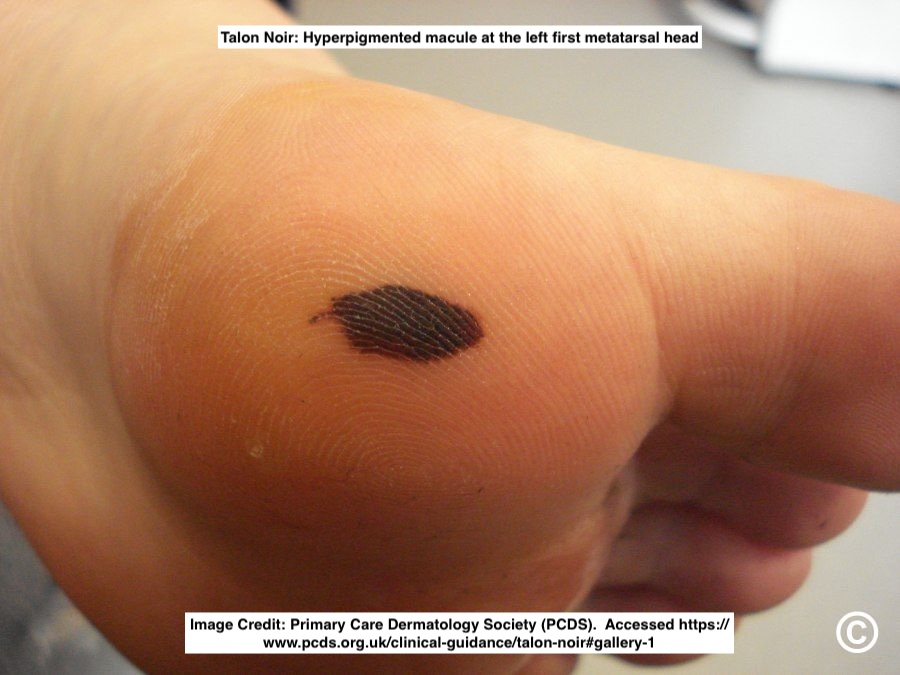 Path4People's tweet image. 🩸 Talon Noir

📖 Benign
⚾️ 🏀 🏈 ⚽️ Often seen in athletes
🩺 Brown-black macules on foot, most commonly on heel
⚠️ May mimic melanoma
🔬  Acral skin, hyperkeratosis, hemorrhage in stratum corneum +/- telangiectatic vessels in papillary dermis

#dermpath #fammed #path4people