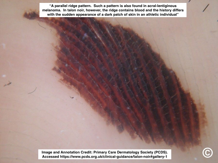 Path4People's tweet image. 🩸 Talon Noir

📖 Benign
⚾️ 🏀 🏈 ⚽️ Often seen in athletes
🩺 Brown-black macules on foot, most commonly on heel
⚠️ May mimic melanoma
🔬  Acral skin, hyperkeratosis, hemorrhage in stratum corneum +/- telangiectatic vessels in papillary dermis

#dermpath #fammed #path4people