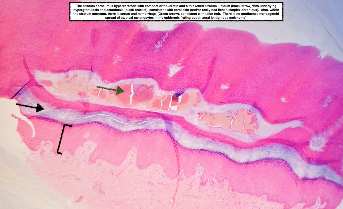 Path4People's tweet image. 🩸 Talon Noir

📖 Benign
⚾️ 🏀 🏈 ⚽️ Often seen in athletes
🩺 Brown-black macules on foot, most commonly on heel
⚠️ May mimic melanoma
🔬  Acral skin, hyperkeratosis, hemorrhage in stratum corneum +/- telangiectatic vessels in papillary dermis

#dermpath #fammed #path4people