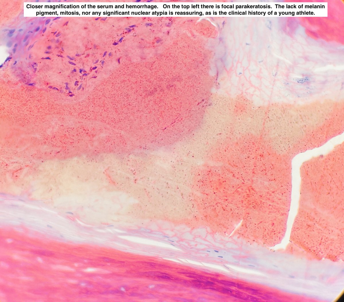 Path4People's tweet image. 🩸 Talon Noir

📖 Benign
⚾️ 🏀 🏈 ⚽️ Often seen in athletes
🩺 Brown-black macules on foot, most commonly on heel
⚠️ May mimic melanoma
🔬  Acral skin, hyperkeratosis, hemorrhage in stratum corneum +/- telangiectatic vessels in papillary dermis

#dermpath #fammed #path4people