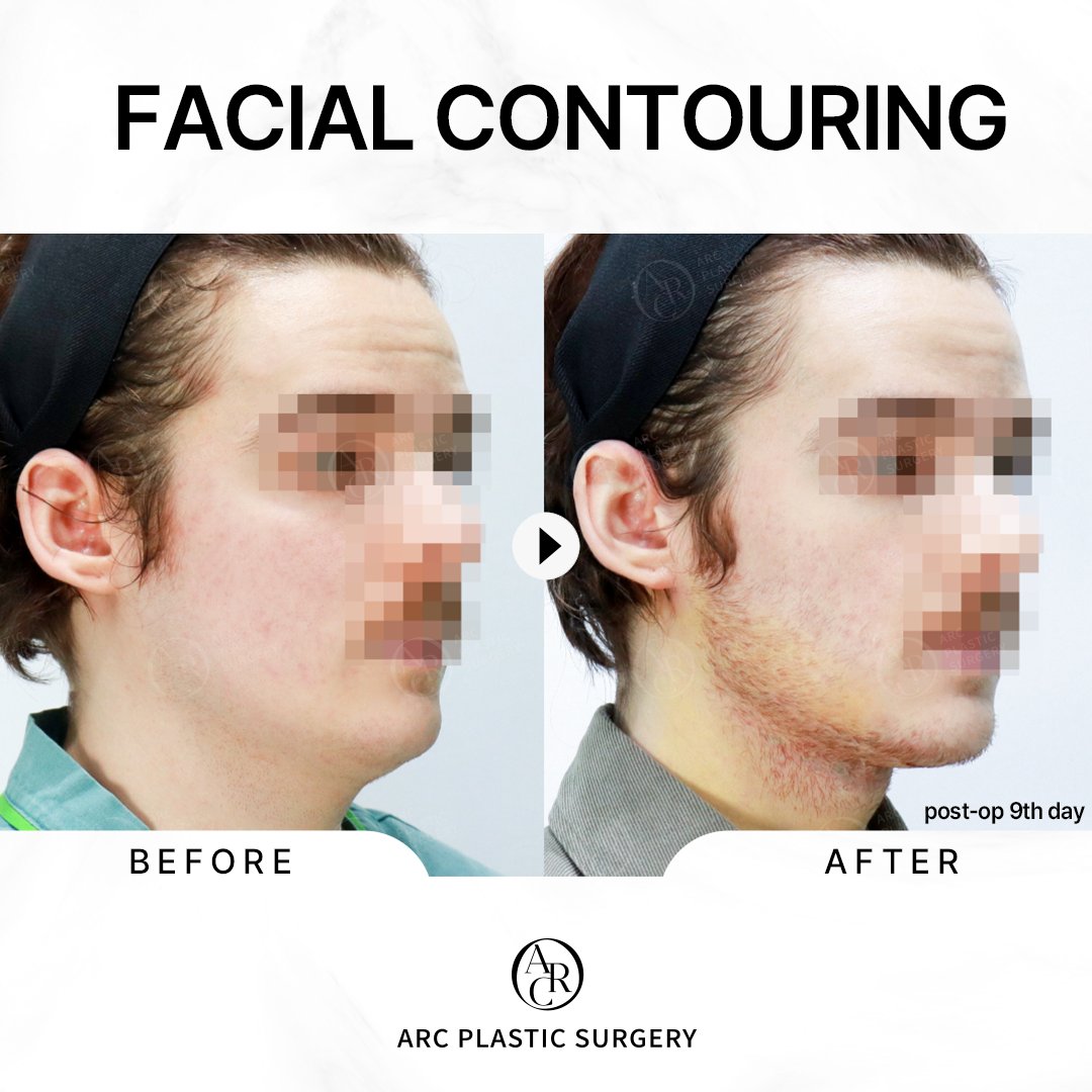 dr_kwonsoonbeom's tweet photo. [FINE ARC]
Soft Tissue Contouring
✔Performed by Dr. Kwon Soon Beom
***
Facial liposuction: Jawline &amp; Double chin
Platysmaplasty (double chin corset)
Sub-platysmal fat removal
***
#platysmaplasty #arcplasticsurgery #drkwonsoonbeom #facialcontouring #아크성형외과 #アーク整形外科 https://t.co/kereezPFQD