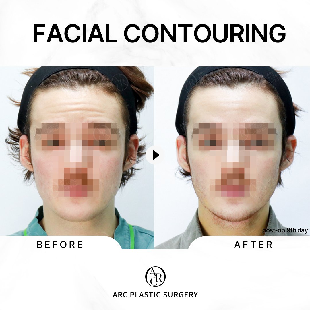 dr_kwonsoonbeom's tweet photo. [FINE ARC]
Soft Tissue Contouring
✔Performed by Dr. Kwon Soon Beom
***
Facial liposuction: Jawline &amp; Double chin
Platysmaplasty (double chin corset)
Sub-platysmal fat removal
***
#platysmaplasty #arcplasticsurgery #drkwonsoonbeom #facialcontouring #아크성형외과 #アーク整形外科 https://t.co/kereezPFQD