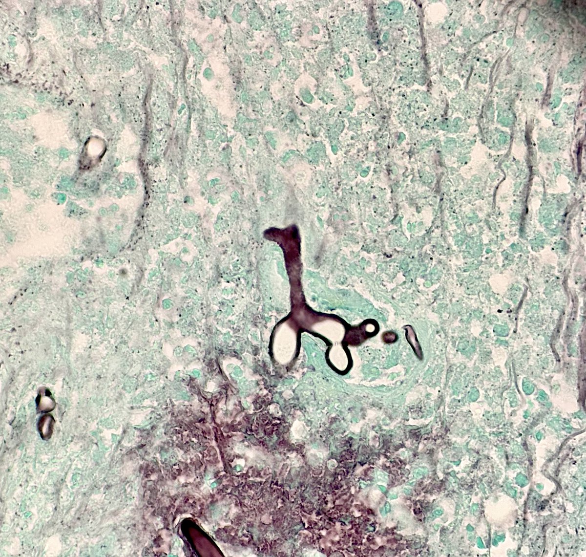 Rokana Taftaf, MD, PhD, MS (@rokanataftaf) on Twitter photo I stumbled upon this adorable fungal hypha during my #microbiology rotation with <a href="/DrNikkiHubbard/">Nicole Hubbard</a>. It looks like it’s ready for trick-or-treating, dressed up as a tiny giraffe!🦒 Who knew fungi could be so cute?! #Pathology #Halloween I stumbled upon this adorable fungal hypha during my #microbiology rotation with <a href="/DrNikkiHubbard/">Nicole Hubbard</a>. It looks like it’s ready for trick-or-treating, dressed up as a tiny giraffe!🦒 Who knew fungi could be so cute?! #Pathology #Halloween
