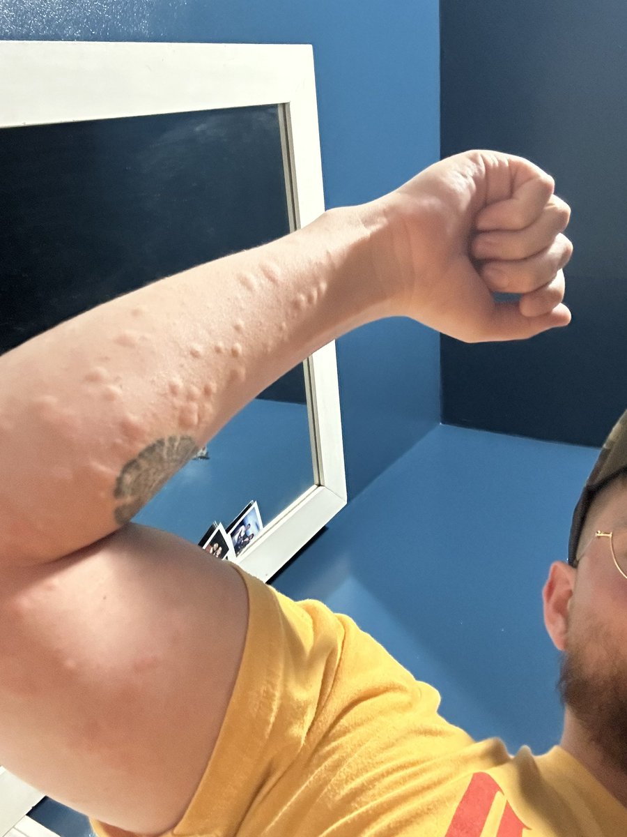 Zach_Kills's tweet photo. Life update — I’m still allergic to almonds https://t.co/Fmk5YXAwOQ